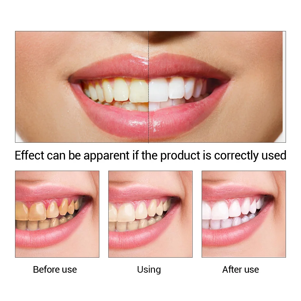 FTEENPLY отбеливание зубов быс – обзор и цена Teeth Whitening Quotes